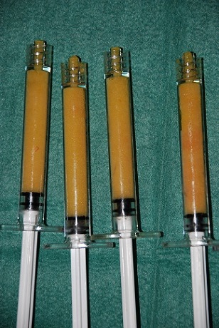 injection-graisse-lipofilling