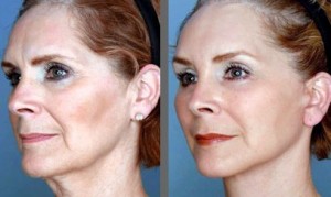 lifting cervico-facial resultat