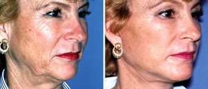 resultat lifting cervico facial