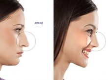 rhinoplastie-tunisie-avant-apres-femme