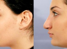 chirurgie esthétique de nez