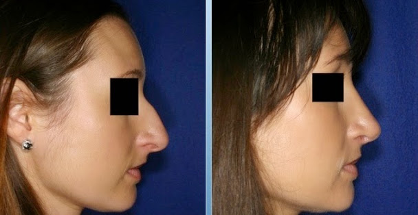 Rhinoplastie Tunisie