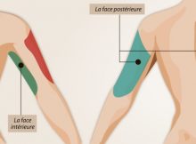 Liposuccion des bras