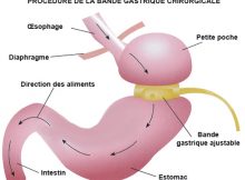 anneau gastrique en tunisie