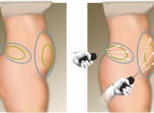 Liposuccion laser 