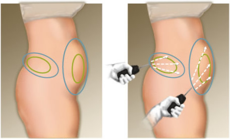 liposuccion laser