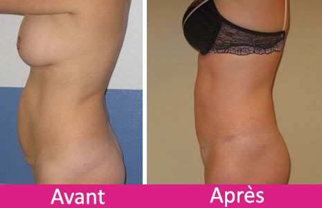 mini-lift abdominal en Tunisie