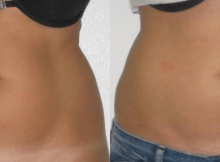 liposculpture abdominale