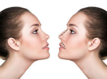 chirurgie esthétique du nez
