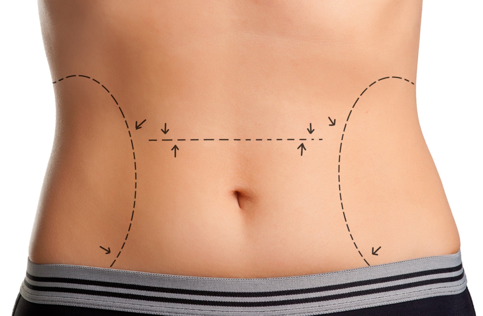 abdominoplastie Tunisie