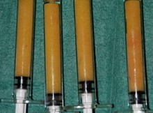 injection-graisse-lipofilling