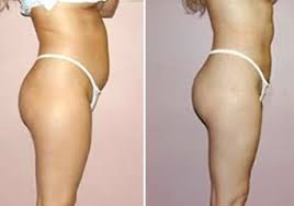 liposuccion tunisie