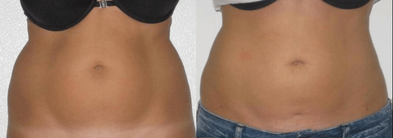 liposculpture abdominale