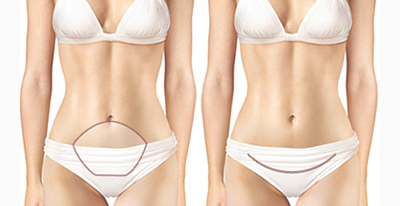 mini-lift abdominal Tunisie