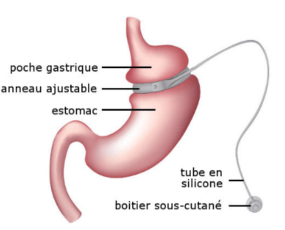 Pose d’anneau gastrique en Tunisie