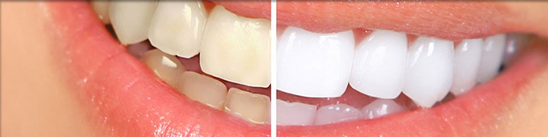 blanchiment des dents en Tunisie