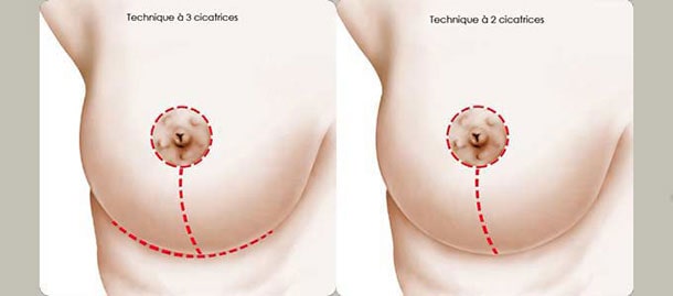 hypertrophie mammaire Tunisie