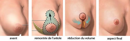 Réduction mammaire Tunisie : âge minimum, cicatrices	