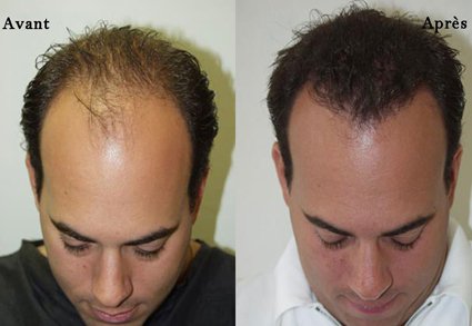 Implant capillaire en Tunisie