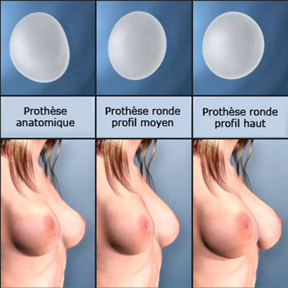 Implant mammaire en Tunisie : Prothèse ronde ou anatomique 